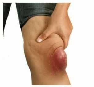 Симптомы воспаления коленного сустава зависят от причины