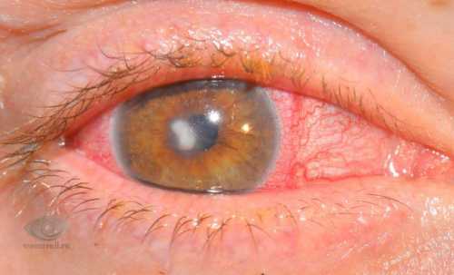 Описываемое заболевание глаза имеет разные формы в зависимости от возбудителя заболевания