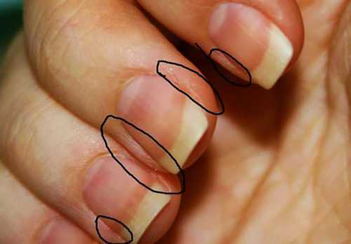 Гной может локализоваться только вокруг ногтевой пластины или затекать под ноготь