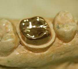 Прогрессивные методы протезирования в современной стоматологии